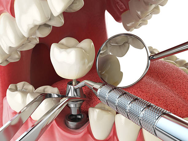 Best Emergency Dentist for Knocked-Out Tooth in Mission, KS